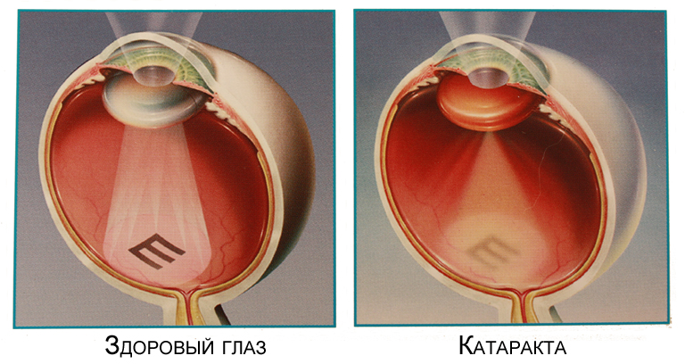 Что такое катаракта: нельзя предотвратить, но можно вылечить