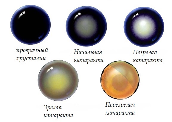 стадии катаракты