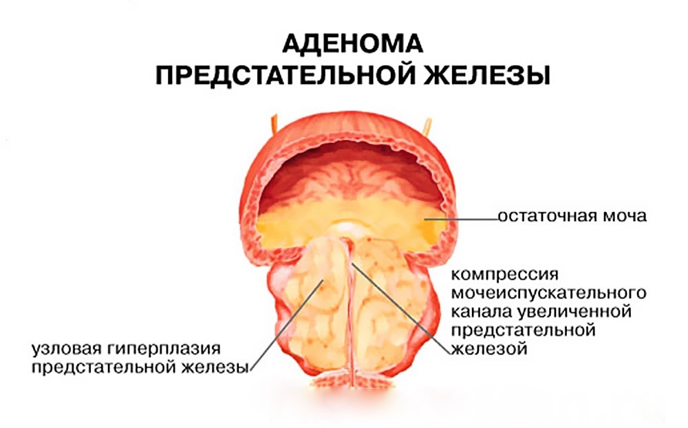 Простата у мужчин питание. Доброкачественная гиперплазия (аденома) предстательной железы. Предстательная железа аденома простаты. Аденома простаты железы. Аденома предстательной железы симптомы.