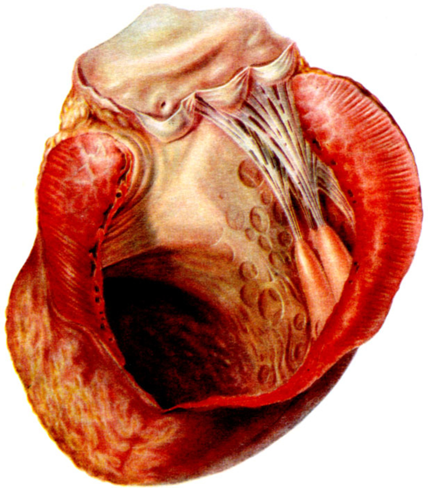Аневризма: аорты, в т.ч. брюшной, сосудов головного мозга, сердца