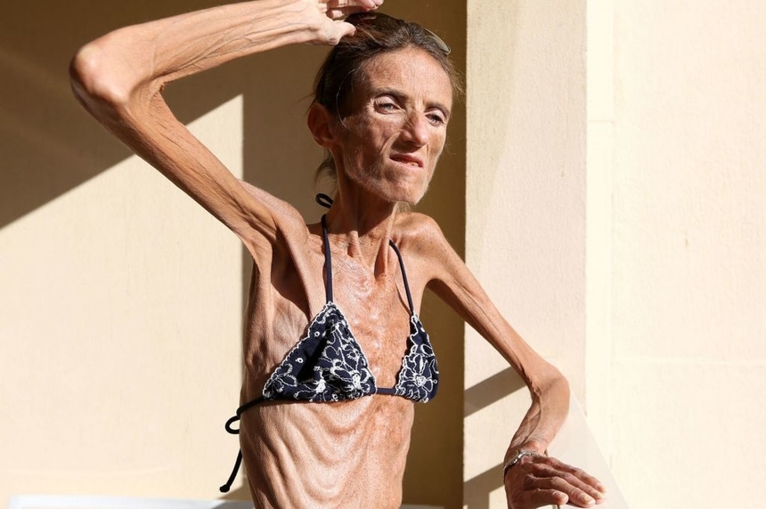 Британка Эмили Брэнд победила анорексию и стала бодибилдершей, фото