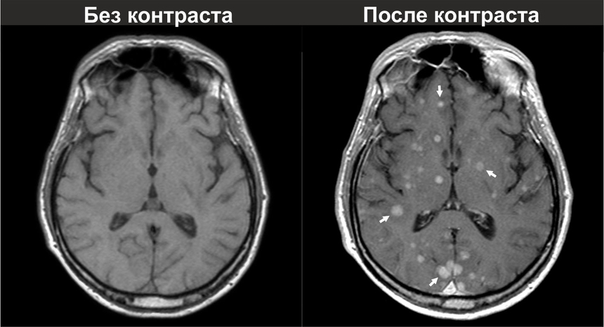 Диагностика рака мозга: МРТ с контрастным усилением