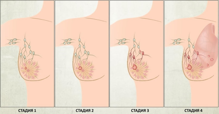Рак Груди1 Симптомы У Женщин Фото