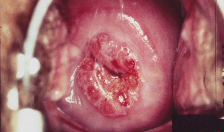 Кабинет патологии шейки матки: лечение эрозии шейки матки, в том числе при беременности