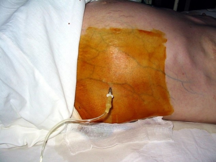 Лечение цирроза печени: удаление свободной жидкости при асците