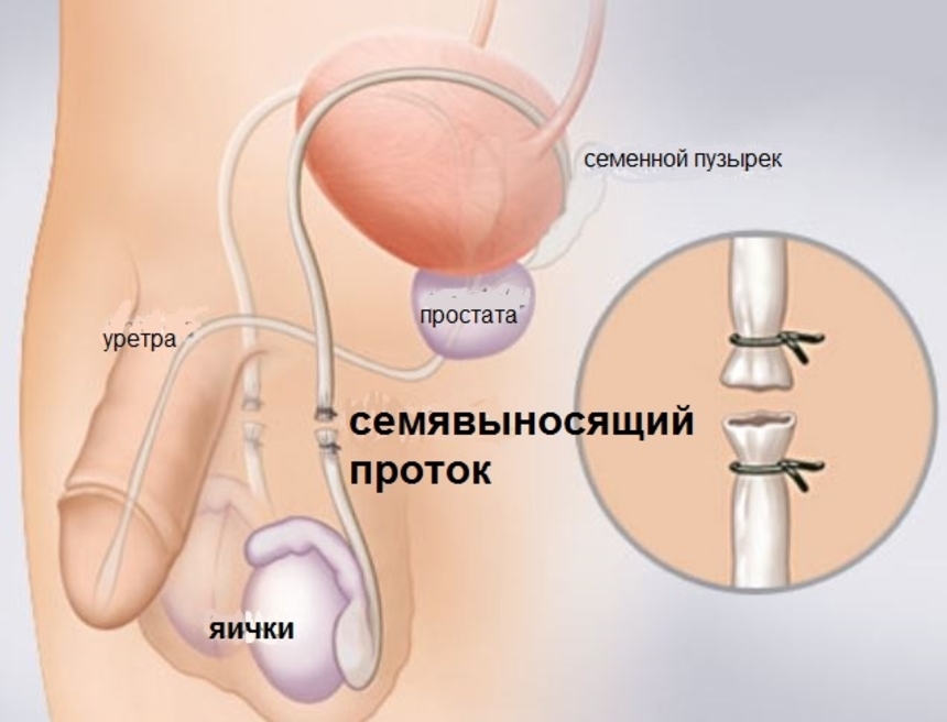 Хирургические методы контрацепции: мужская стерилизация