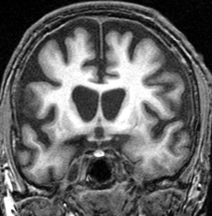 Диагностика деменции: МРТ головного мозга