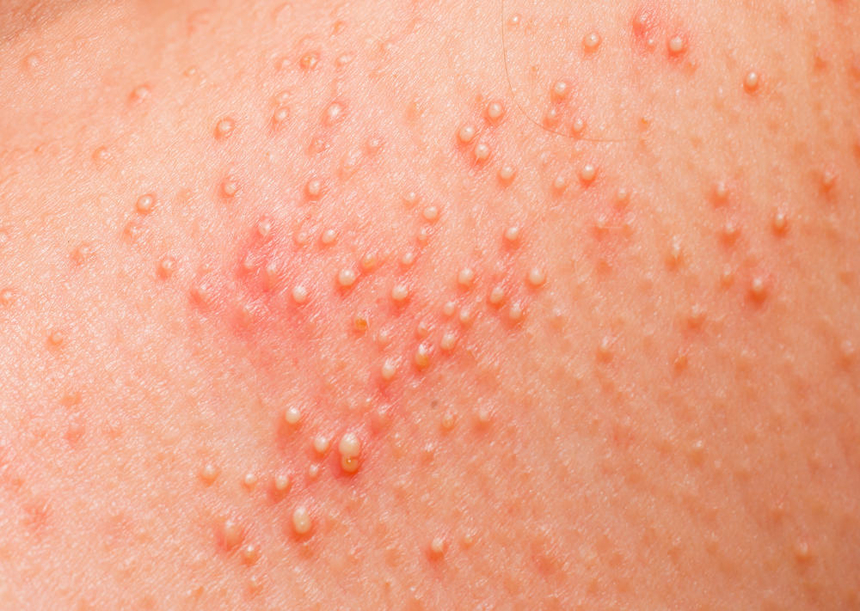 Разновидности и симптомы дерматита: аллергический дерматит