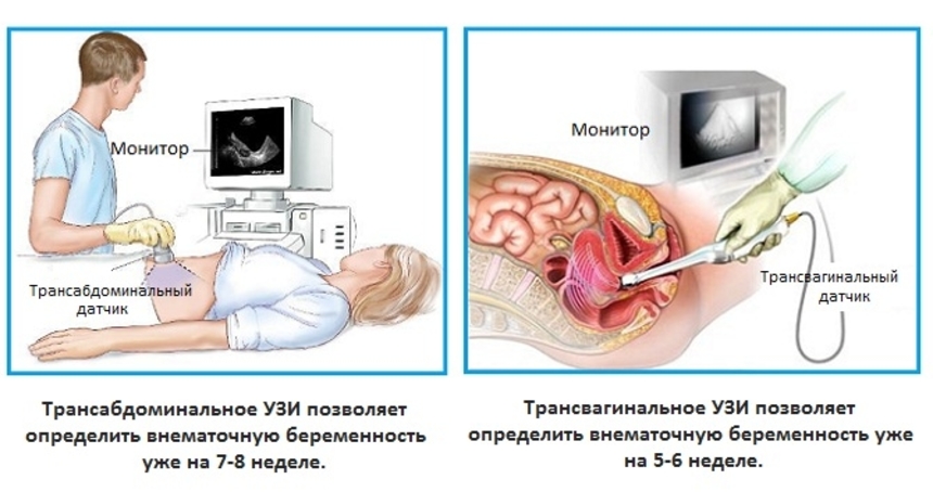 Внематочная беременность: причины и симптомы | Диагностика и операция в «СМ-Клиника»