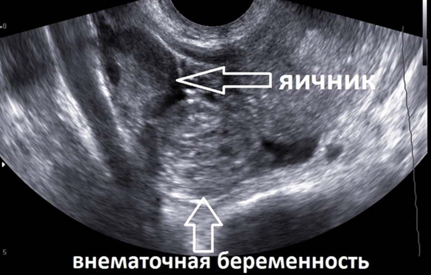 Что такое внематочная беременность - данные УЗИ