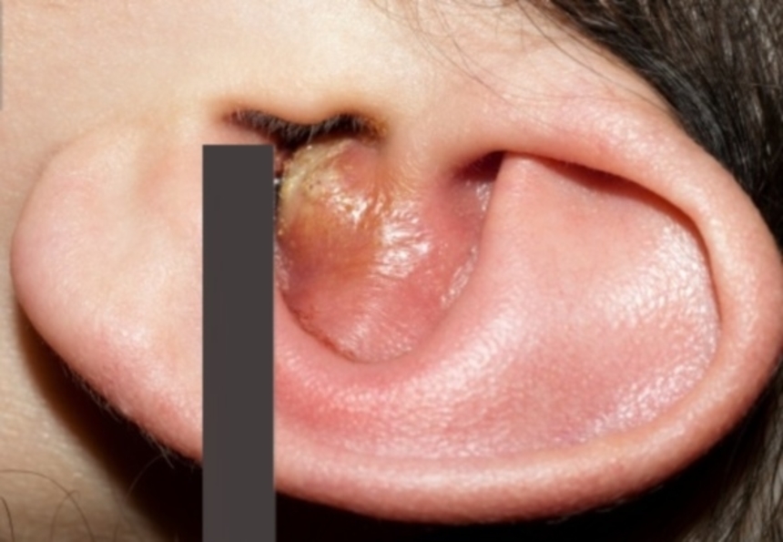 Фурункул и карбункул: фото, в ухе, на лице, на попе; лечение