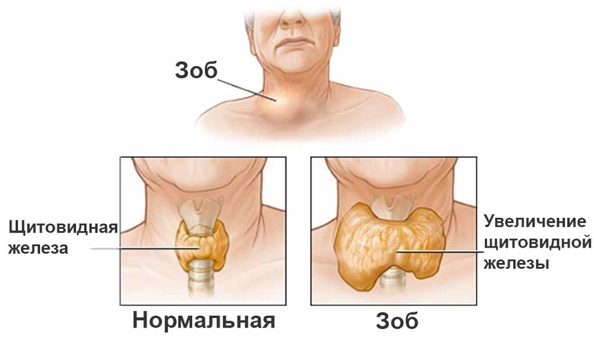 Узлы щитовидной железы. Клиника Щитовидной Железы доктора А. В. Ушакова — официальный сайт.