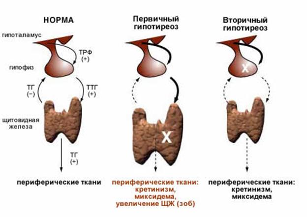 Субклинический гипотиреоз на фоне хаит