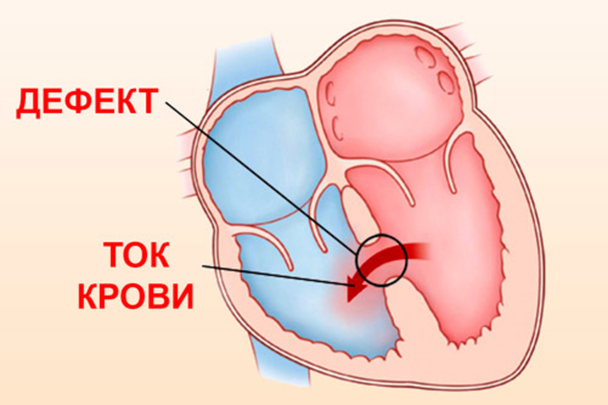 Причины шумов в сердце у детей и взрослых – информация для пациентов — клиника «Добробут»