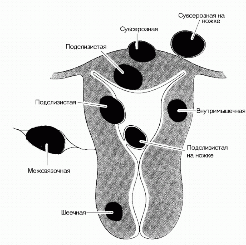 Классификация по расположению узлов миомы матки