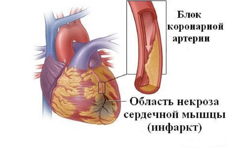 Потливость при инфаркте миокарда