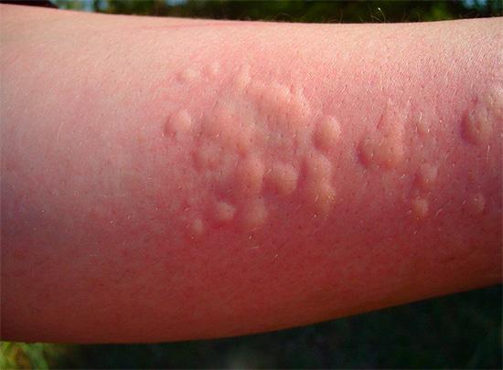 Аллергия на солнце: причины, симптомы и лечение