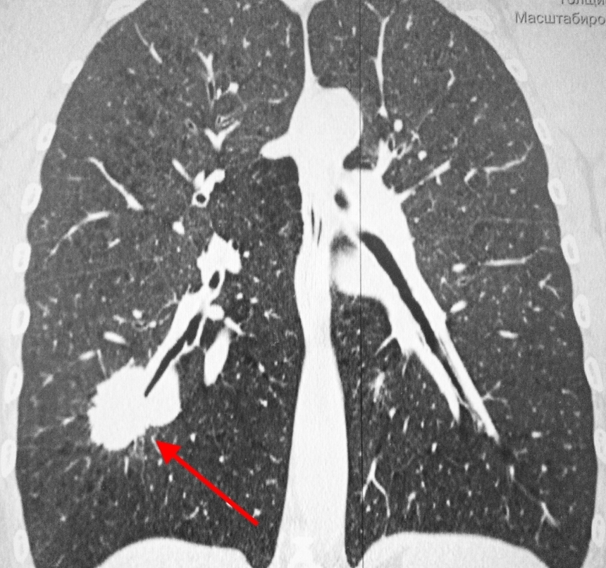 Диагностика рака легких: компьютерная томография