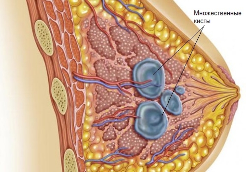 Виды мастопатии: кисты в молочной железе при мастопатии