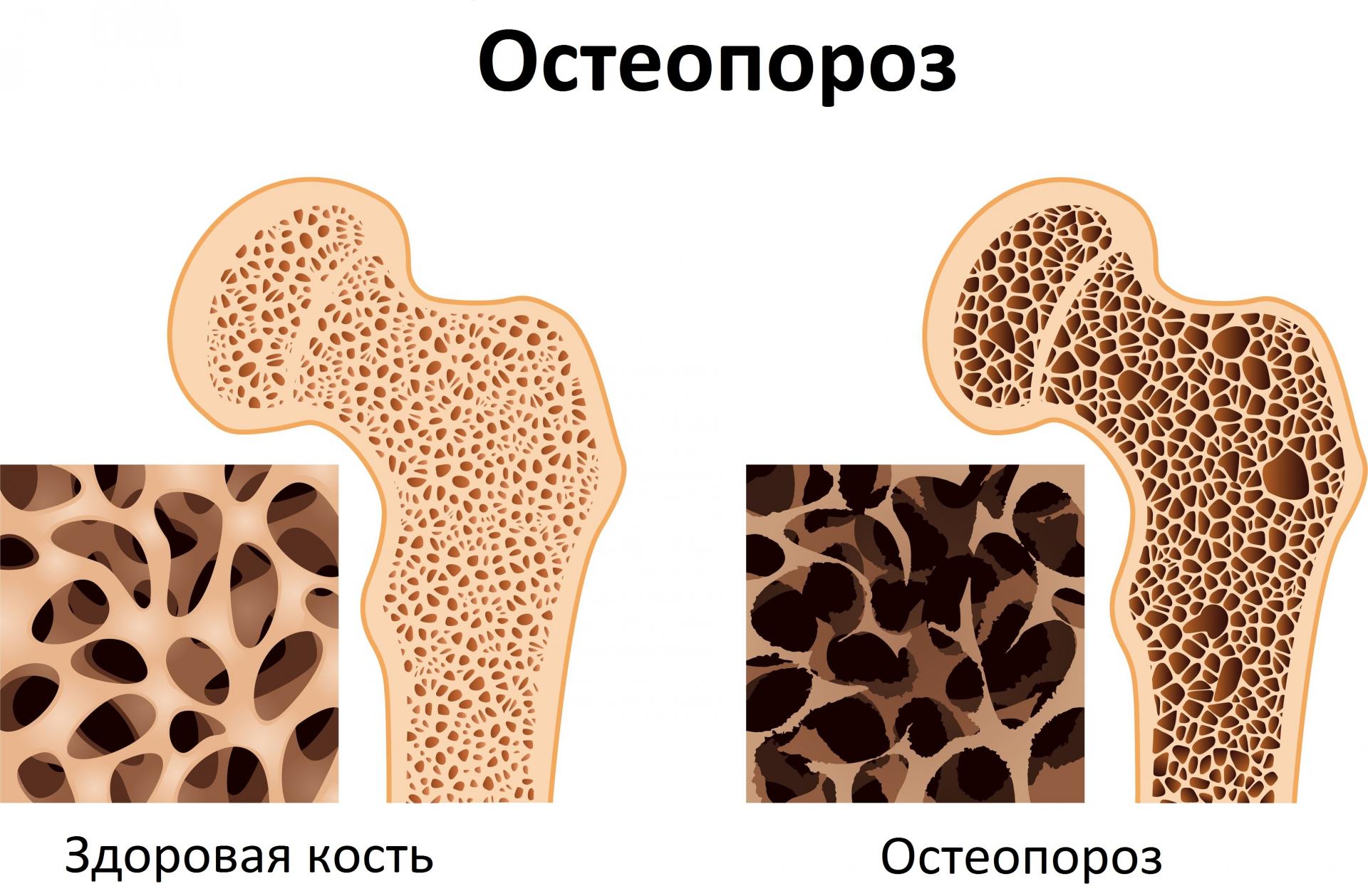 Остеопороз: лечение народными средствами