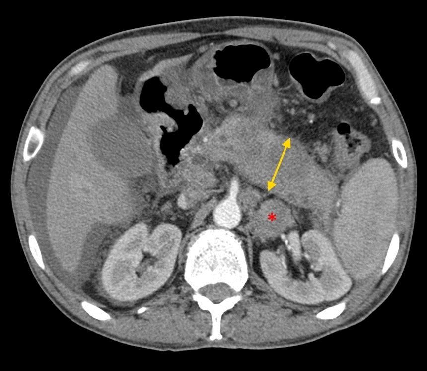 Диагностика рака поджелудочной железы: компьютерная томография