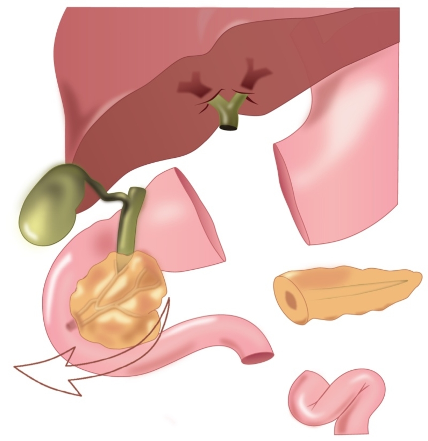 Лечение рака поджелудочной железы: панкреатодуоденальная резекция