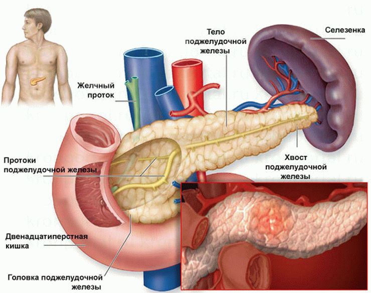 Панкреатит поджелудочной железы: симптомы и лечение | Клиника Рассвет