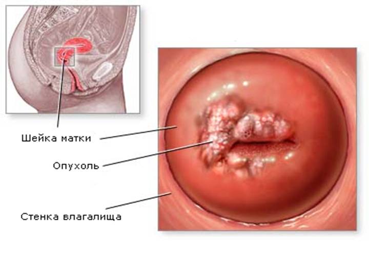 Папилломы половых органов