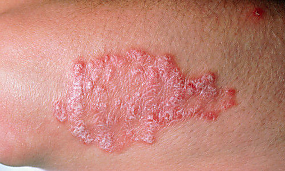 Дерматомикозы – грибковые заболевания кожи