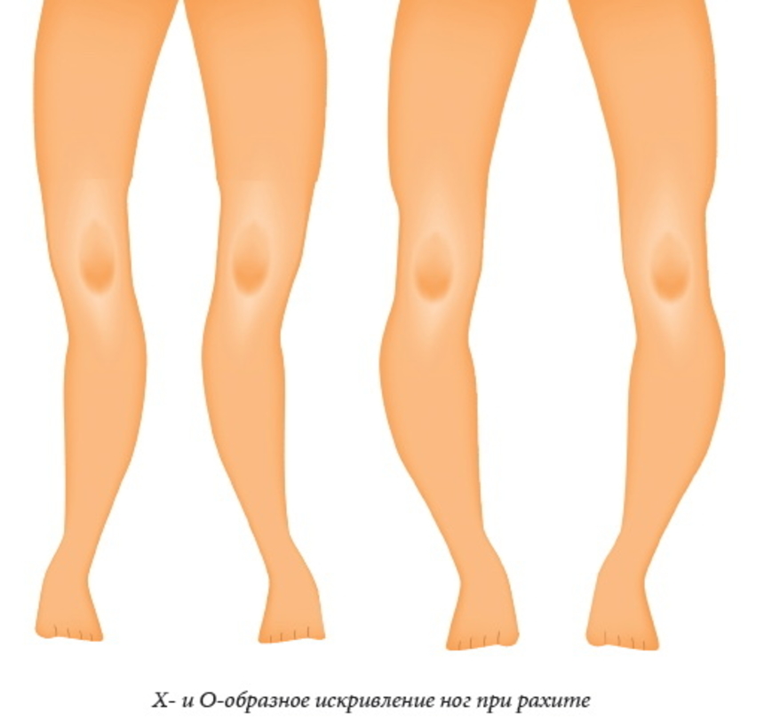 Симптомы рахита: X- и О-образное искривление ног при рахите - следствие остеомаляции