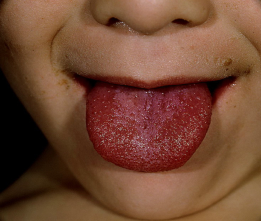 Симптомы скарлатины: малиновый язык