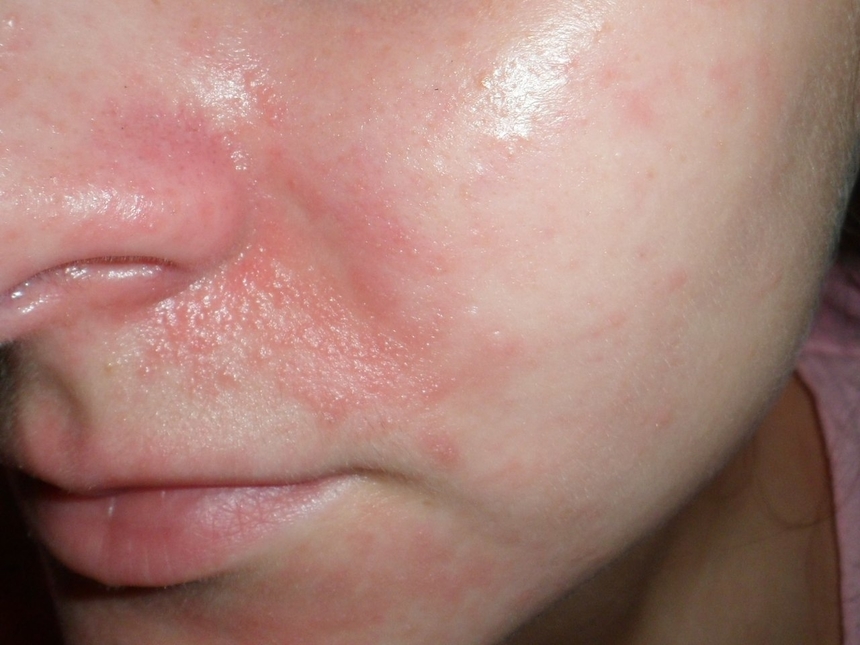 Лечение себореи на лице