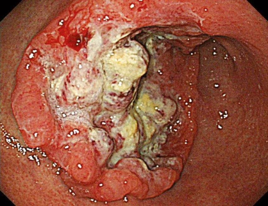 Проявления рака желудка фото thumbnail