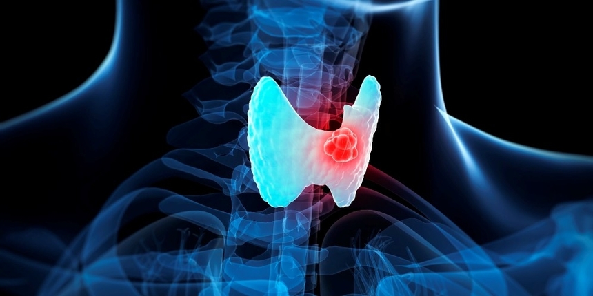Рак щитовидной железы – причины, симптомы и лечение