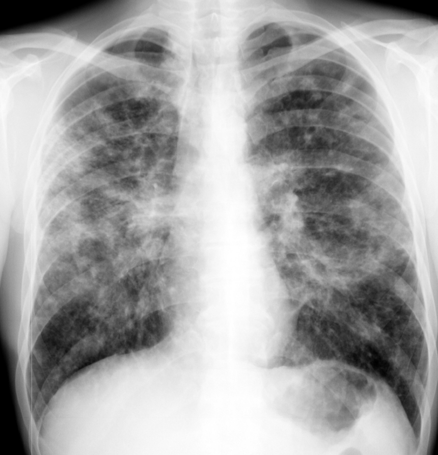 Диагностика туберкулеза: рентгенография легких